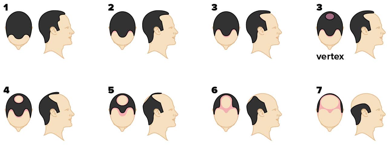 Norwood hair loss scale